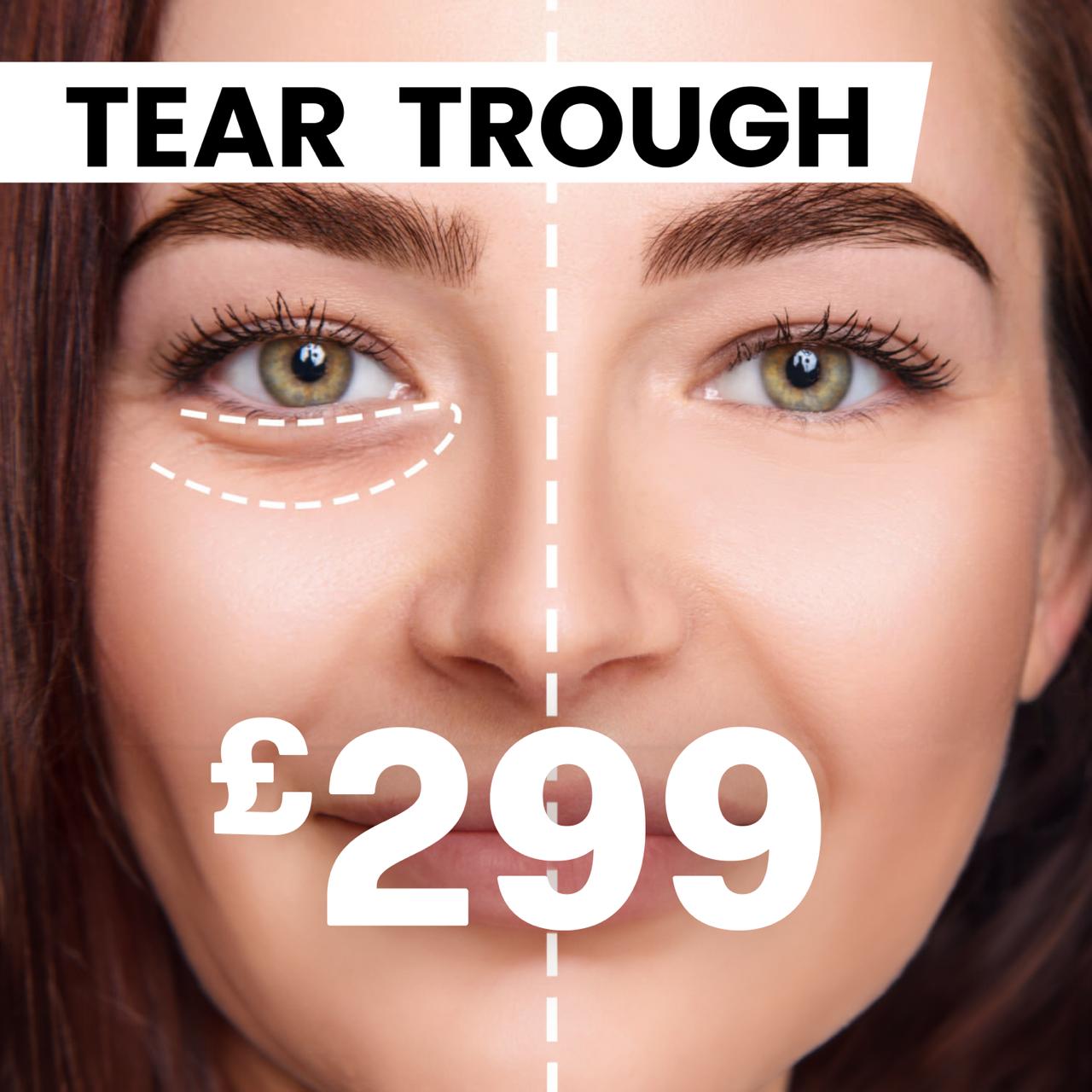 Tear trough £299